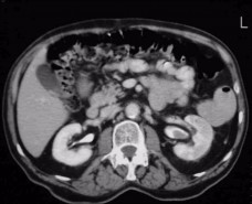 Axial CT Scan of Abdomen