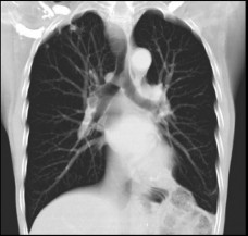 Lung CT Scan (1)