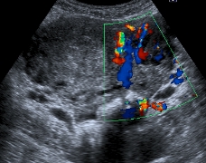 Ultrasound scan of pelvic varicose veins