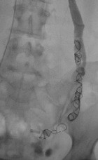 Embolisation-coils-in-left-ovarian-vein-140x228