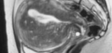 MRI-Adenomyosis-179x228